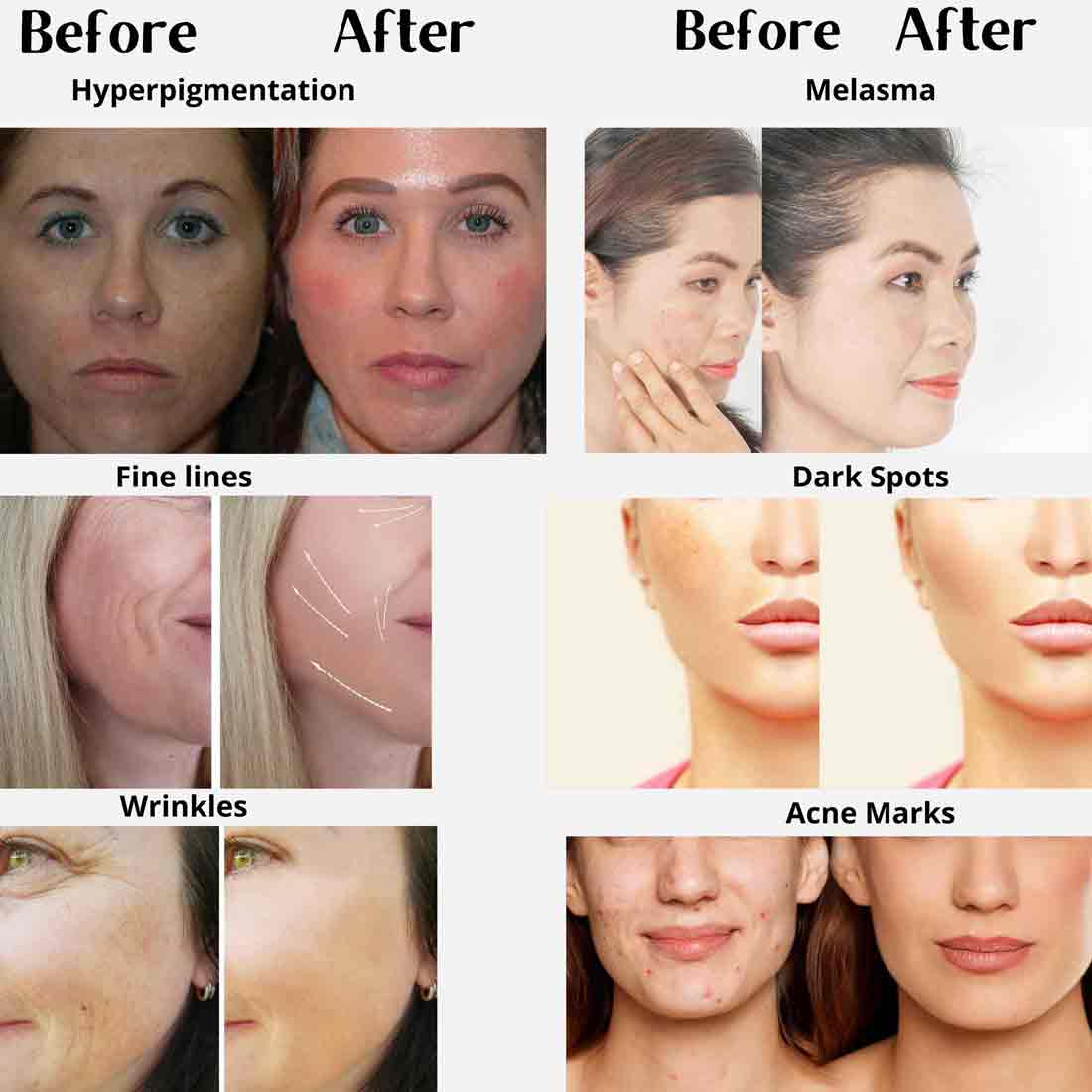 Collage showing before and after results of a facial cream treatment on various skin concerns: Hyperpigmentation, Melasma, Fine Lines, Dark Spots, Wrinkles, and Acne Marks.
