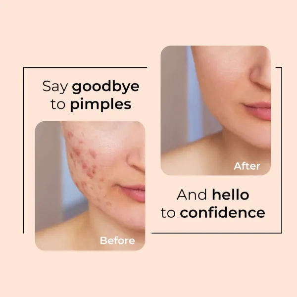Facial Cleanser for Acne Marks and Pimples - Image 2