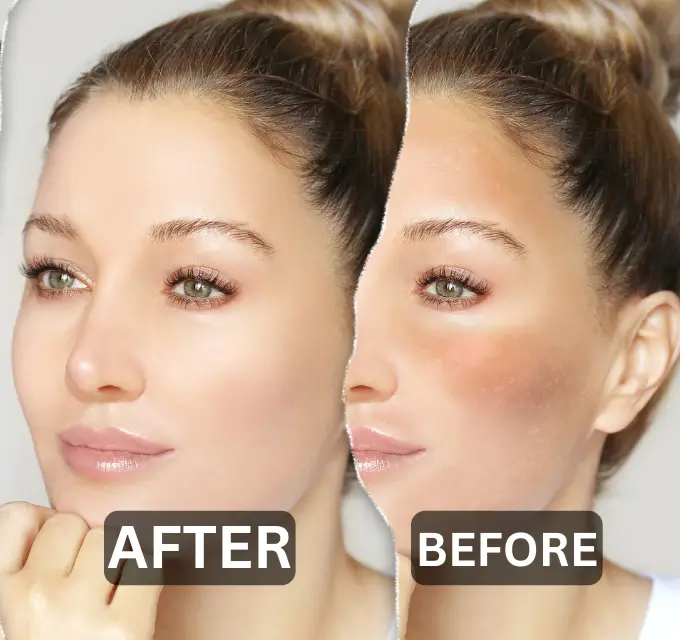 hyperpigmentation Before and After Results