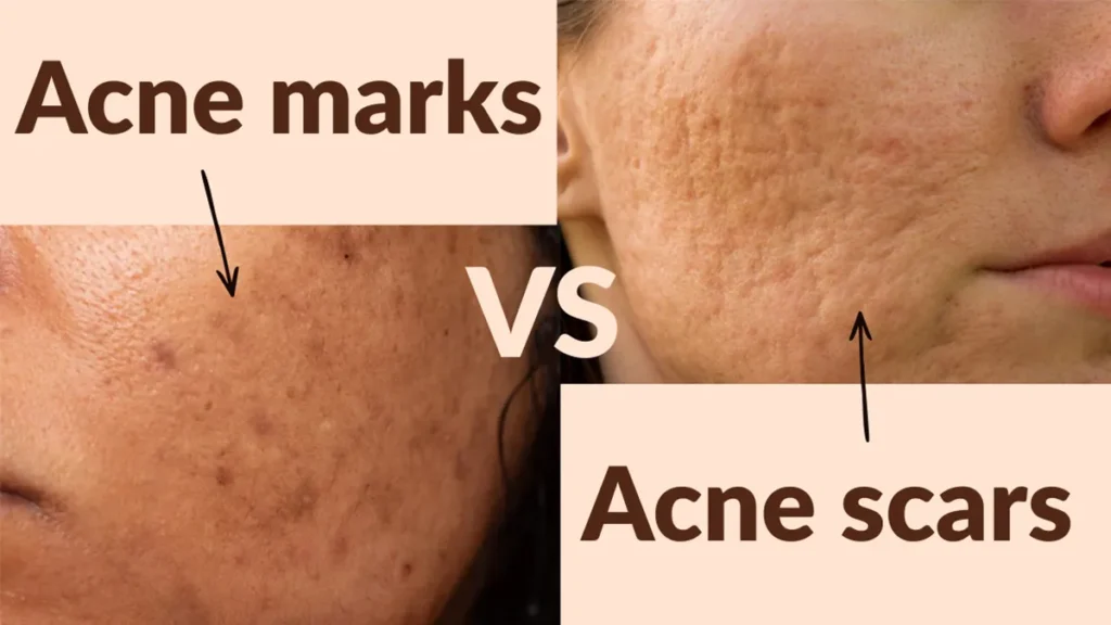 Acne marks vs acne scars – flat coloured marks compared with indented scars